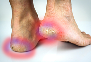 heel pain